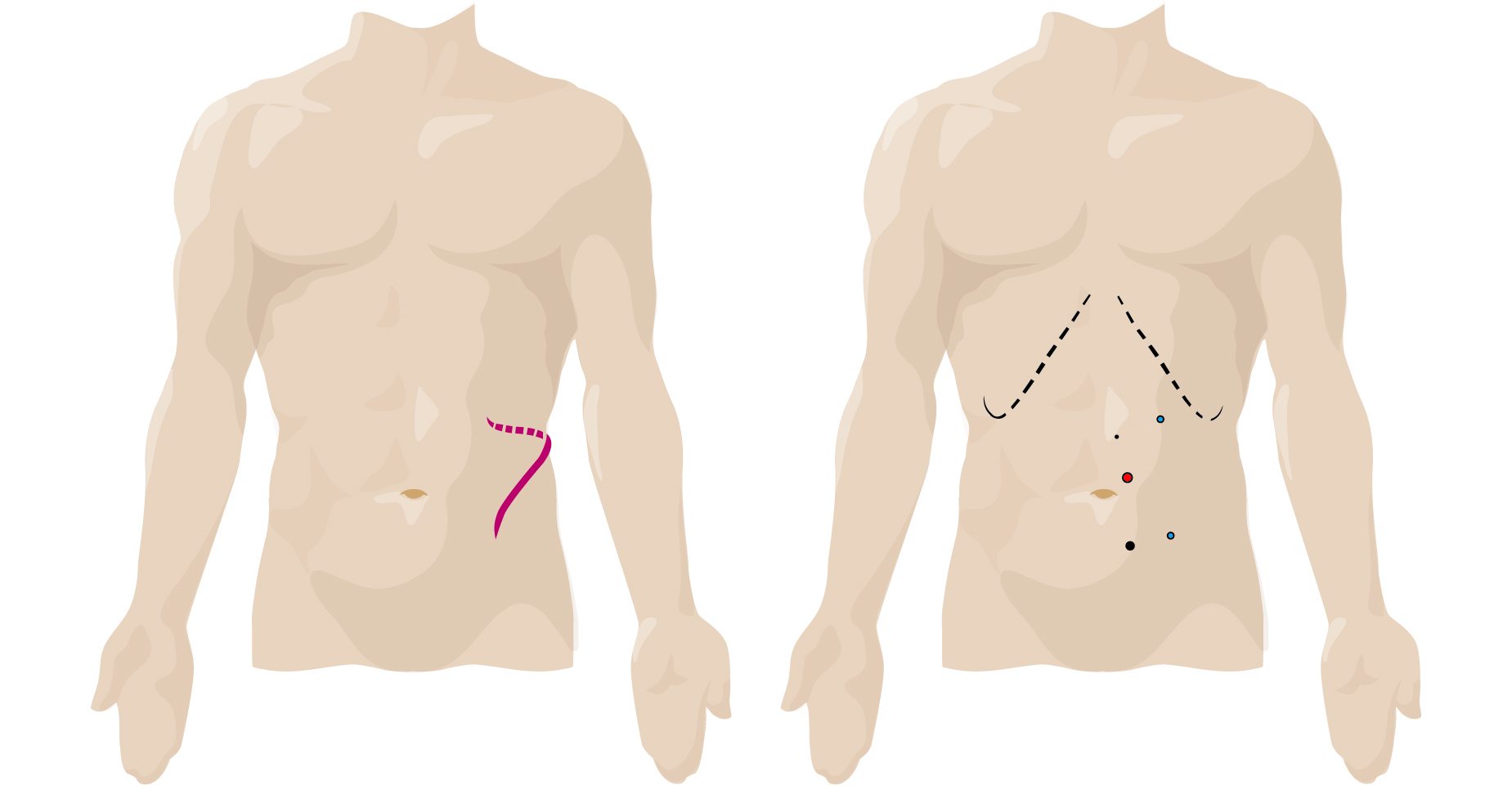 We offer daVinci Robotic Partial Nephrectomy