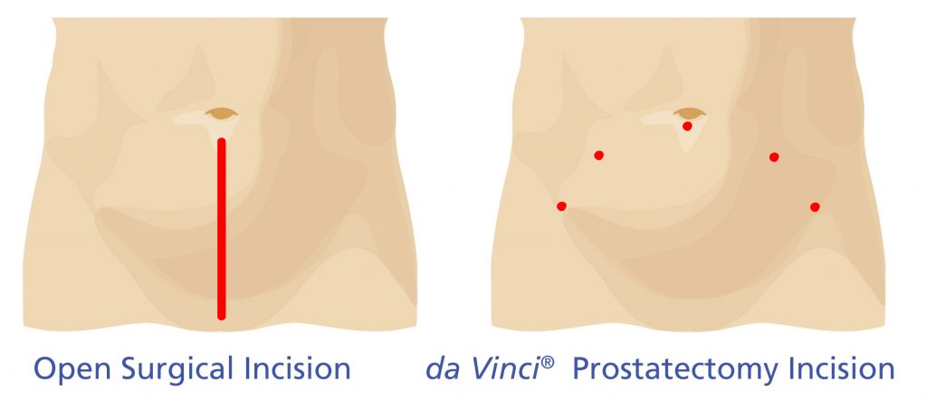 da Vinci incision comparison at AUS