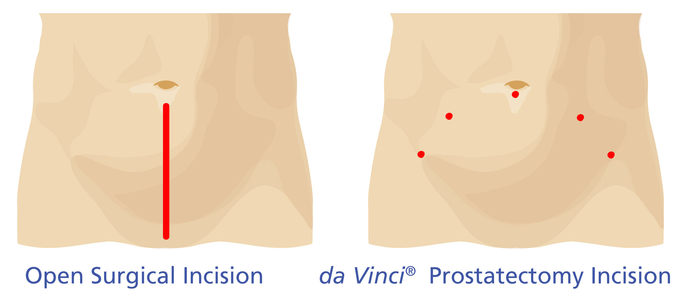 RALP incision comparison