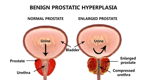 prostate cancer benign hypertrophy