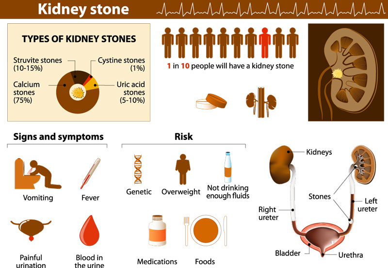 Kidney Stones Associated Urological Specialists