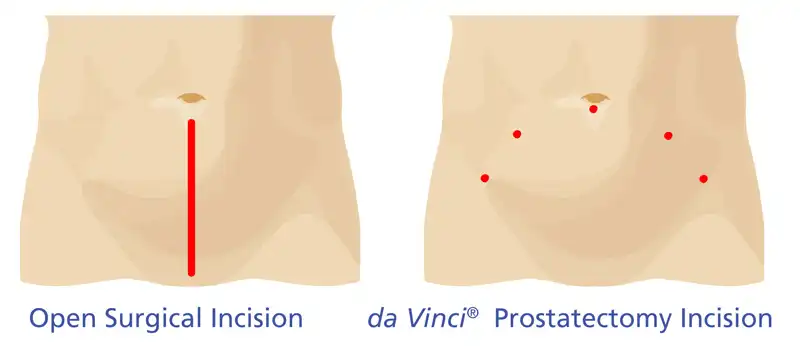 da Vinci Prostatectomy Comparison