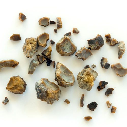 types of kidney stones in men