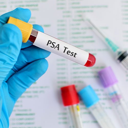 PSA Test for Prostate Cancer at Associated Urological Specialists